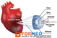 Ударно-волновая терапия сердечно-сосудистых заболеваний Кардиоспек (Cardiospec) 